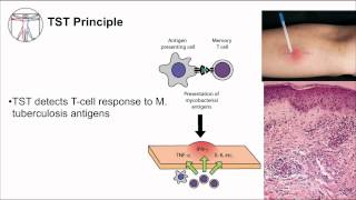 Tuberculosis Diagnosis [upl. by Atekal363]