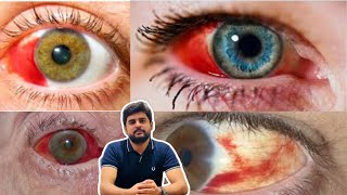 Subconjunctival hemorrhage eye blood education optometry drhashimjabbar subcribemychannel [upl. by Enimajneb]