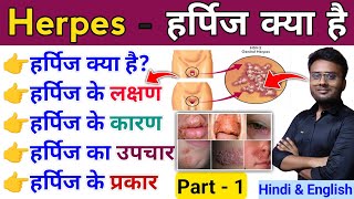 हर्पिज क्या है हर्पिज के लक्षण हर्पिज के कारण हर्पिज का उपचार Genital Herpes  Herpes Treatment [upl. by Eyak]