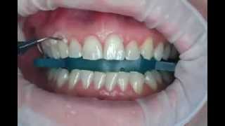 What is Teeth Bleaching [upl. by Woodsum434]