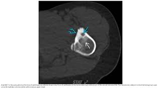 Osteoid Osteoma Imaging [upl. by Nolyarb]