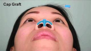 Asian Rhinoplasty Tip Augmentation Case Study Part 2  Dr Thomas Buonassisi 8 West Clinic in BC [upl. by Rekab]