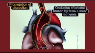 Physiopathology of aortic dissection [upl. by Beaufert]