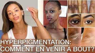 Hyperpigmentation Conseils amp Ma Routine Pour sen débarrasser [upl. by Salchunas649]