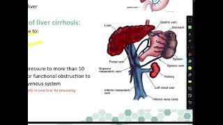 GIM liver cirrhosisAdeem batch [upl. by Ybeloc981]