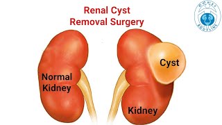 Laparoscopic Renal Cyst Deroofing Bodylinehospitals by drutsavshahurologist done successfully [upl. by Swetiana]