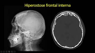 Hiperostose frontal interna [upl. by Wooldridge]