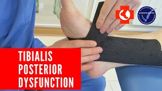 Taping painful TIBIALIS POSTERIOR TENDON [upl. by Noelani348]