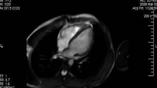 Cardiología HU  Resonancia Magnética Cardiaca Normal [upl. by Ellek119]