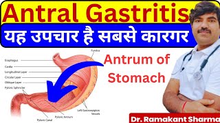 Antral Gastritis Causes Symptoms and Effective Treatments drramakantsharma7 [upl. by Ztnaj495]