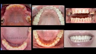 Lucrare dentara  coroane dentare ZIRCONIU  Implant dentar [upl. by Larianna]