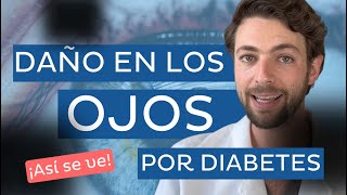 SEÑALES de DAÑO en los OJOS por DIABETES 👀 retinopatía diabética [upl. by Sikras]