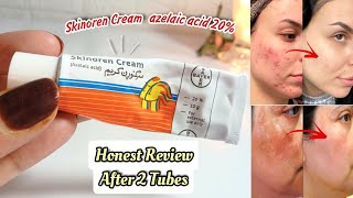 SKINOREN CREAM BEFORE AND AFTER  SKINOREN CREAM REVIEW [upl. by Audley137]