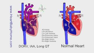 65  DORV interrupted Aortic Arch Long QT Williams Syndrome [upl. by Giraldo]