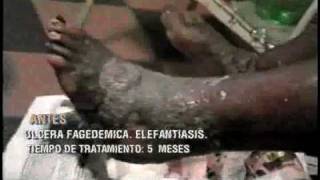 Elefantiasis con ulcera  Elephantiasis with ulcer [upl. by Celestyna469]