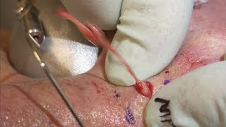 Little popper show stopper cyst Inflamed cyst in between the eyes that packs quite a pop ID [upl. by Berthoud]