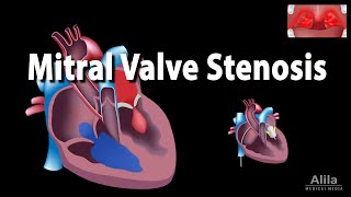 Mitral Valve Stenosis Animation [upl. by Rey]