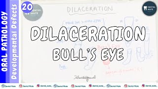 Dilaceration  Bull’s eye appearance  Developmental disturbances in shape of tooth  Dr Paridhi [upl. by Ecinaj]