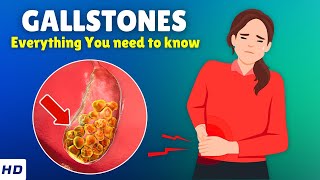 Gallstones – Causes Signs and Symptoms Diagnosis amp Treatment [upl. by Clementis]