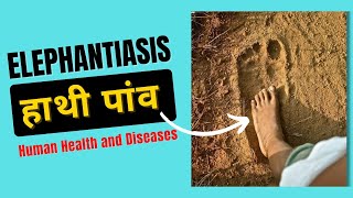 Elephantiasis Symptoms  Filariasis Class 12  Human Health and Diseases [upl. by Dlorrej]