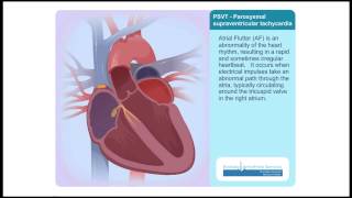 PSVT Paroxysmal Supraventricular Tachycardia Animation Video [upl. by Nyltiac]