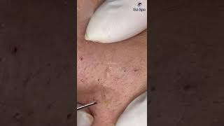 Customers squeeze acne at GaSpa Clinic gaspa phongkhamdalieu acne shortsvideo [upl. by Bernardina]