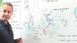 Emphysema  Clinical Presentation Diagnosis and Management [upl. by Yadsnil]