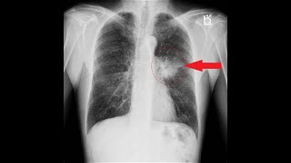 Bronchogenic Carcinoma  Chest X Rays [upl. by Tremann]