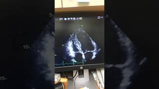 Echocardiogram with Low Ejection Fraction 42 Percent [upl. by Cassady723]