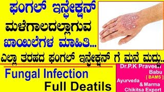 Skin Fungal Infections Symptoms Causes Treatments  Ayurveda tips in Kannada  DrPraveen Babu [upl. by Koblas]