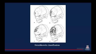 Imaging Characteristics of Hyperostosis Frontalis Interna [upl. by Agbogla]