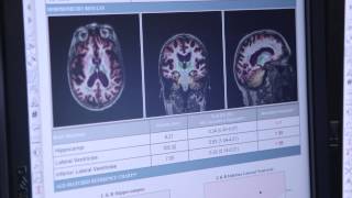 Introduction to CorTechs Labs and NeuroQuant [upl. by Naoj]