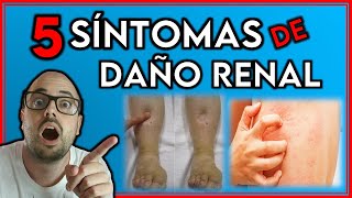 5 SINTOMAS que INDICAN que tus RIÑONES están ENFERMOS  SINTOMAS de INSUFICIENCIA RENAL [upl. by Aman]