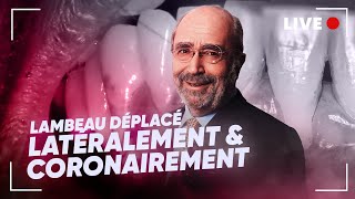 En Direct  🔴 Lambeau déplacé latéralement amp coronairement 🦷 [upl. by Ardnassak]