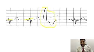 Mastering ECGLesson17 PVCs amp PACs  premature ventricular amp atrial contractions [upl. by Akli]