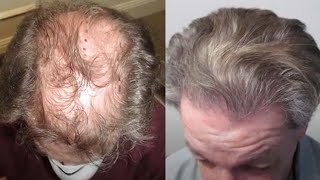 No Shave FUE Hair Transplant Testimonial [upl. by Annez56]