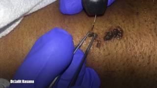 WART REMOVAL Magical Result by DR LALIT KASANA [upl. by Suirtimed]