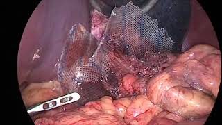 Laparoscopic repair of giant hiatus hernia with composite mesh [upl. by Sueaddaht801]