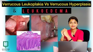 Leukoedema  Verrucous Hyperplasia  Lecture 29  BDS  MDS  Epithelial Tumours  Oral Pathology [upl. by Aytnahs]