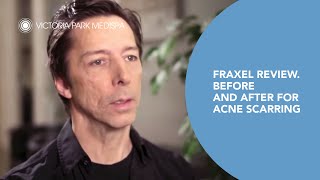 Fraxel Review Before and After for Acne Scarring  Victoria Park [upl. by Naiviv]