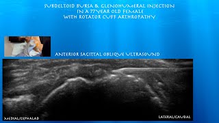 Ultrasound Guided Subdeltoid Bursa Glenohumeral injection in a Female with Rotator Cuff Arthropathy [upl. by Dorree]