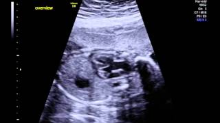 Tetralogy of Fallot with pulmonary stenosis overview [upl. by Burnaby38]