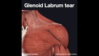 Glenoid labrum tear [upl. by Piggy]