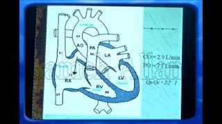 congenital heart disease ASD 1 [upl. by Nitin]