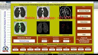 Lung Cancer Detection and Classification Using Deep Learning CNN Matlab Project With Source Code [upl. by Atinej]