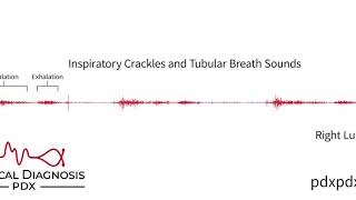 The Lung Sounds of Pneumonia [upl. by Naujaj]