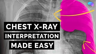 Chest Xray Interpretation  How to Read a CXR  OSCE Guide  UKMLA  CPSA [upl. by Aryek979]