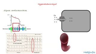 Hypercalcémie Signes cliniques [upl. by Ashli]