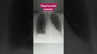 HIPERTENSION ARTERIAL MAGNIFICACIÓN DE LA SILUETA CARDIACA [upl. by Atilrahc]