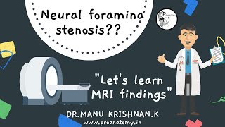 What is quotNeural Foramina StenosisNeural foramina narrowingquot amp spinal nerve root compression [upl. by Carolan149]